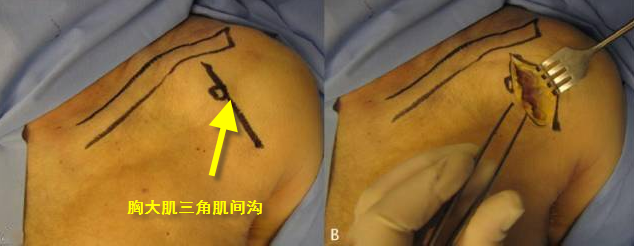進行鬆解 , 經皮膚, 皮下組織 , 三角肌到 達目標位置 ,此處沒有重要