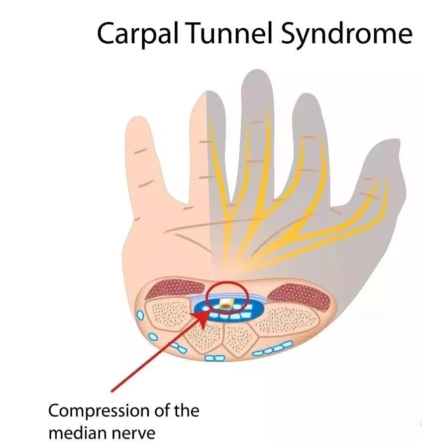 腕管综合症检查示图图片