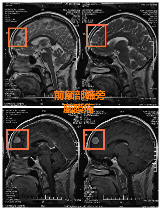 大脑镰旁脑膜瘤图片