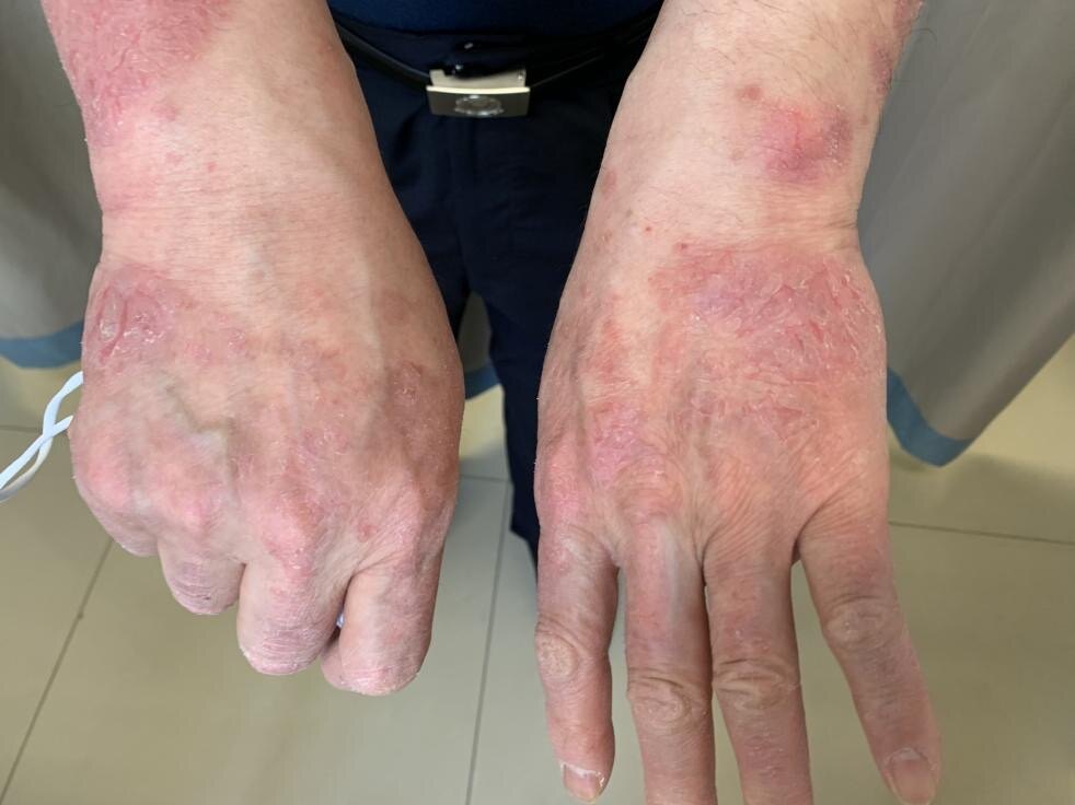 结合入院前做过的肺部ct检查排除结核病引起的结果异常,应属于银屑病