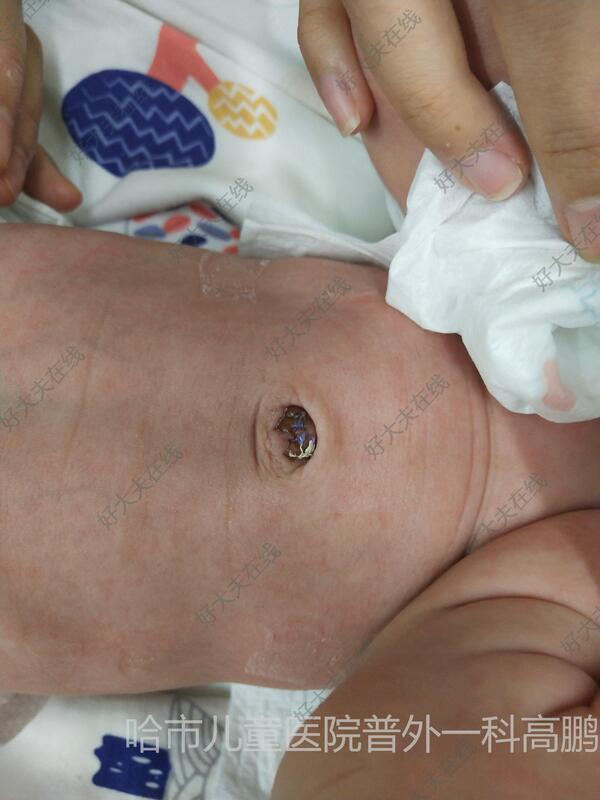 新生儿脐窦的照片图片