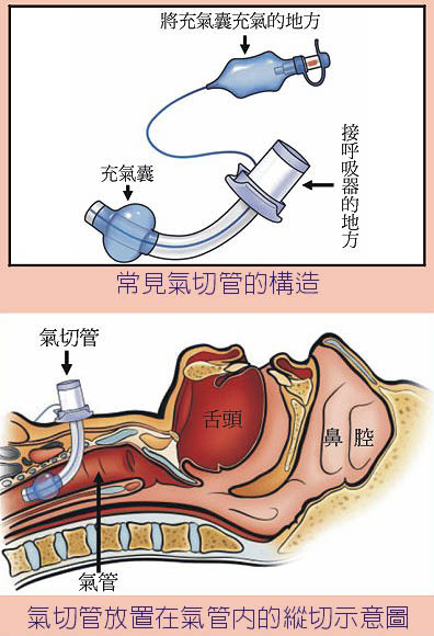 气管食管推移训练图片图片