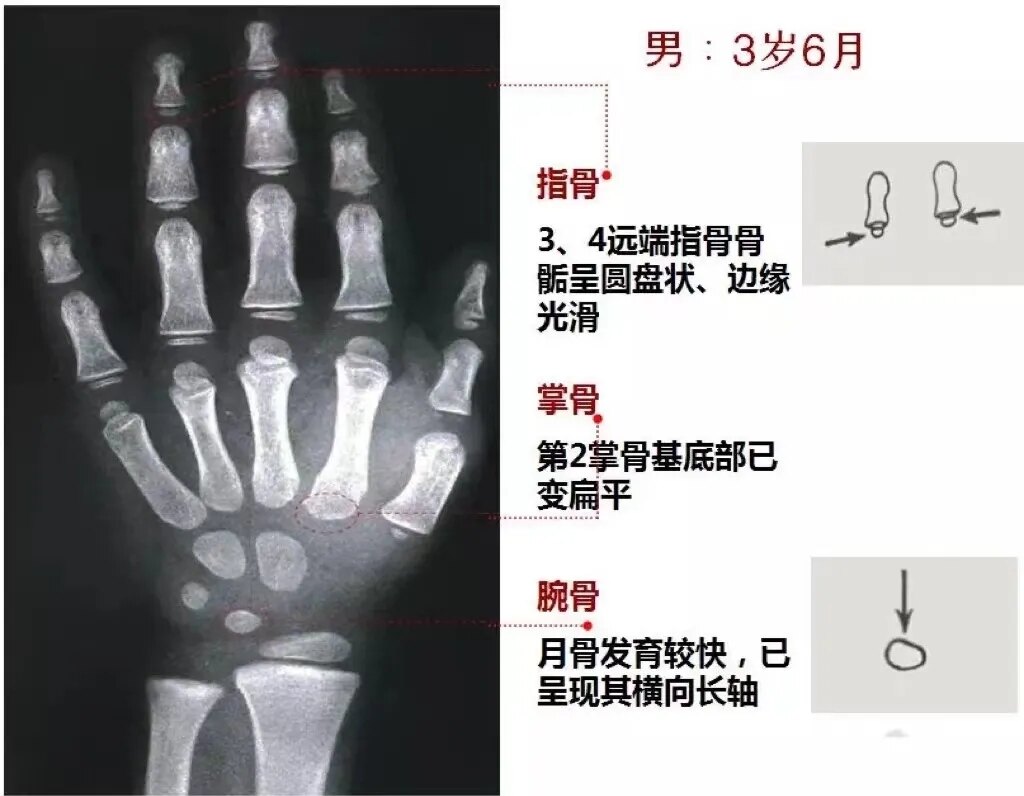 男孩骨龄对照图图片