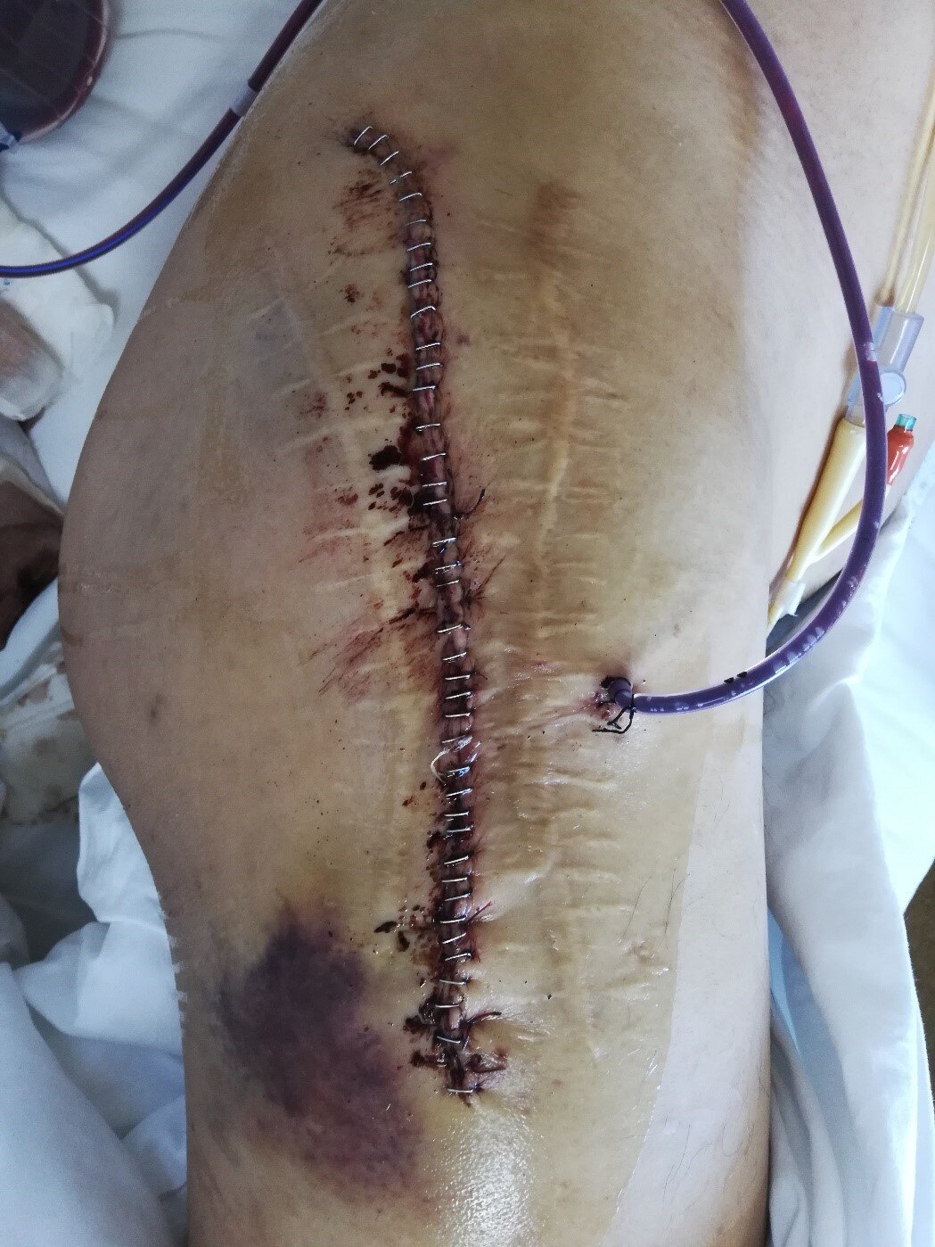 图12 钉皮钉缝合伤口术后第3天,换药时的伤口恢复情况可见多次伤口