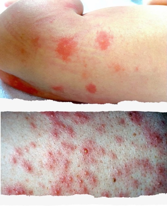 最常见的皮肤问题就是痱子(热疹),外泌汗腺汗管在角质层水平被角蛋白