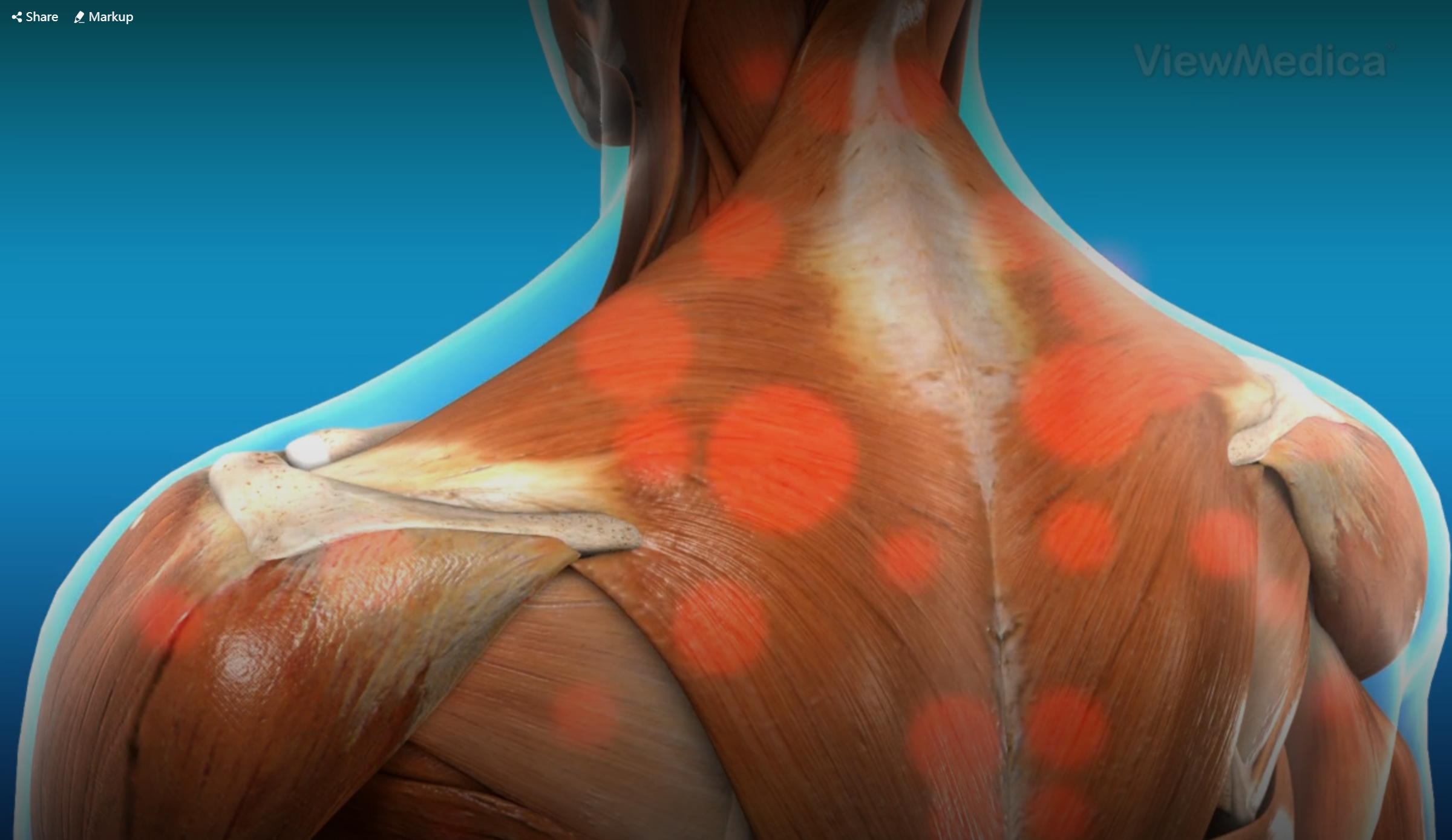 颈肩肌筋膜炎_筋膜炎 - 好大夫在线