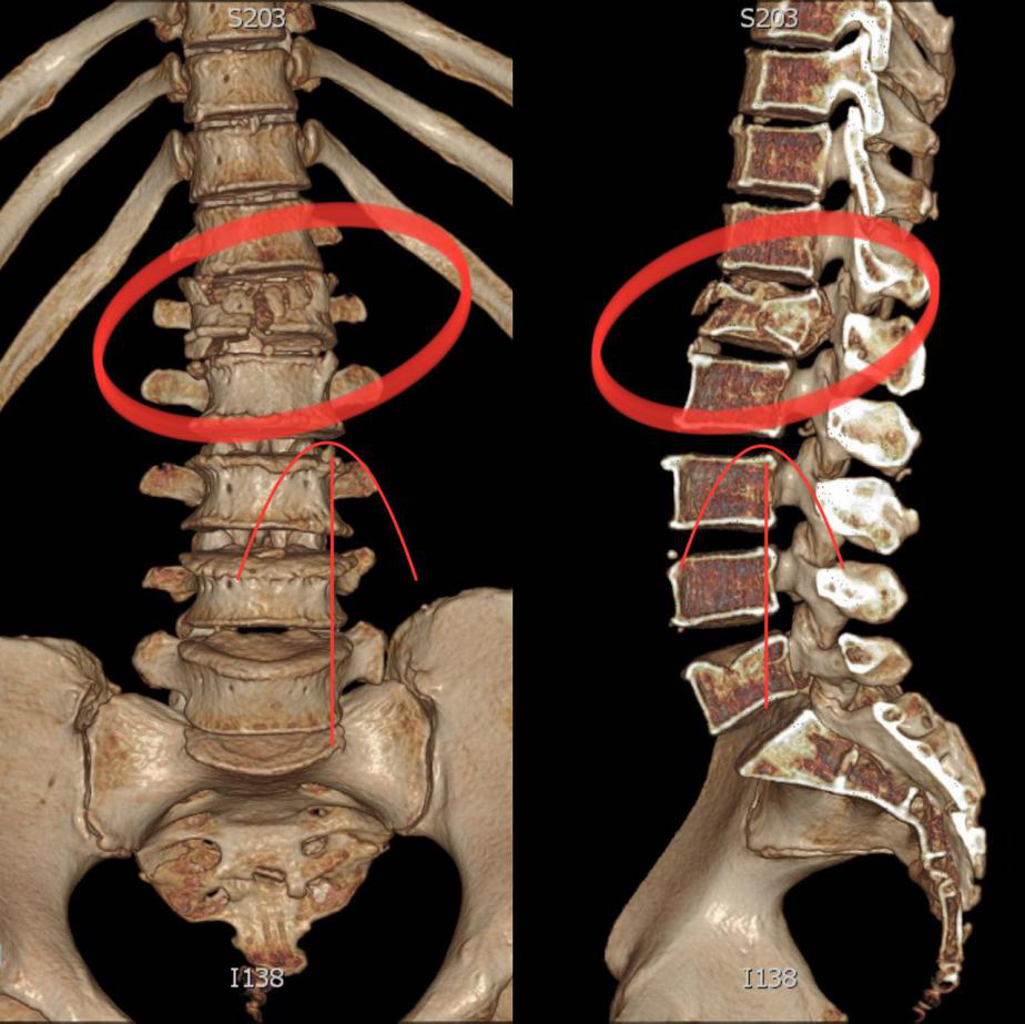 腰2椎体位置图片图片