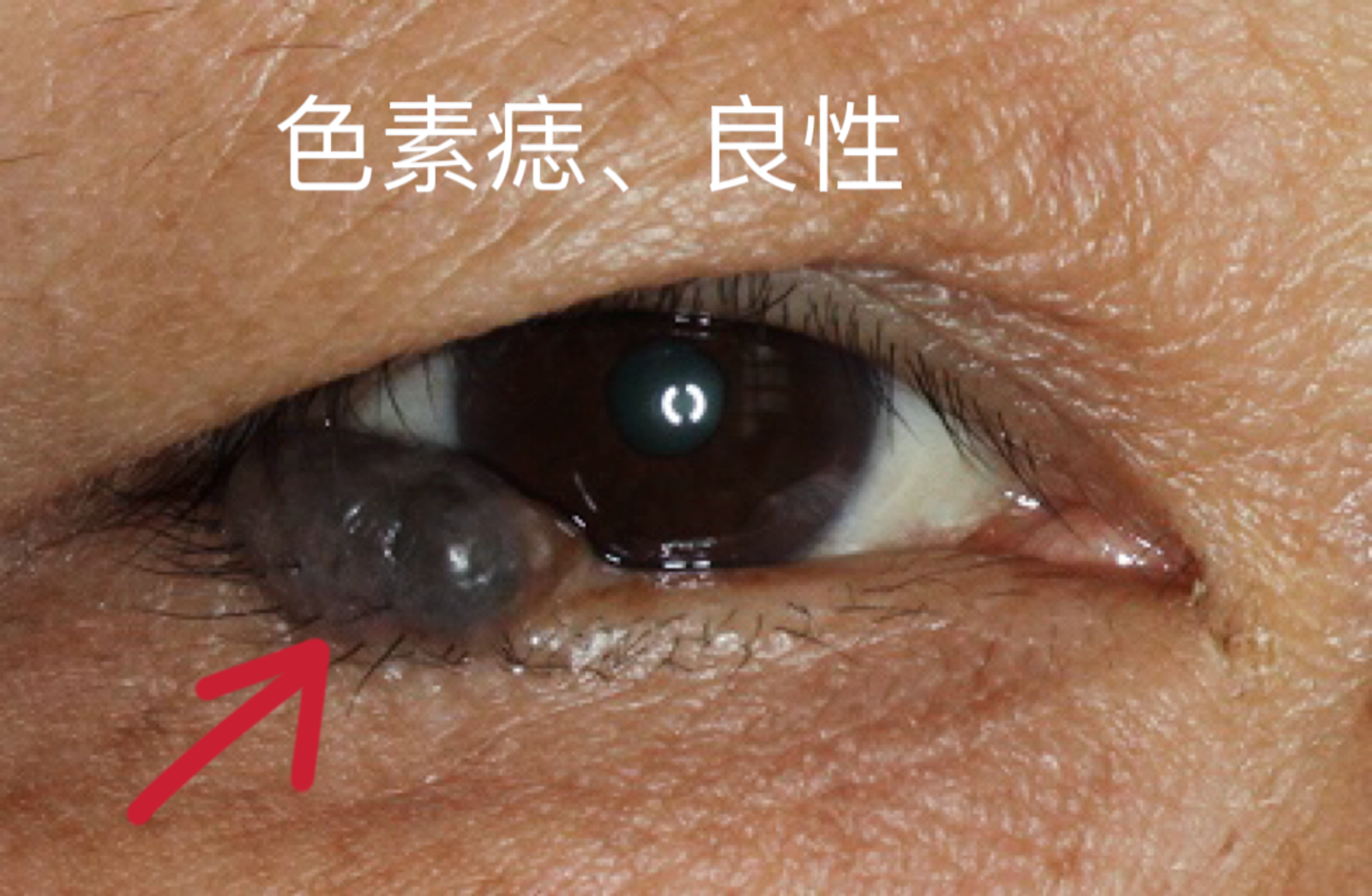 常见眼睑肿瘤图片(良,恶性)