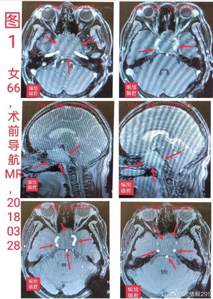巨大侵袭性垂体腺四年随访结果_垂体瘤_检查_治疗方式 - 好大夫在线