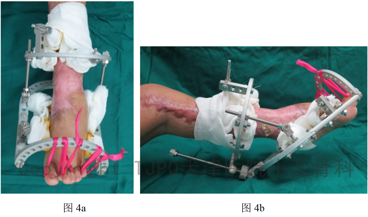 tjpo儿童矫形科普10ilizarov技术矫正儿童创伤后马蹄内翻足