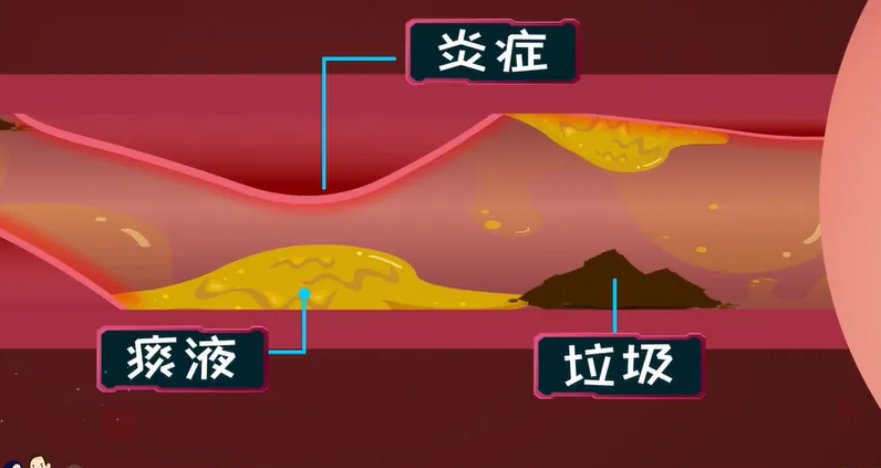 气道情况.png