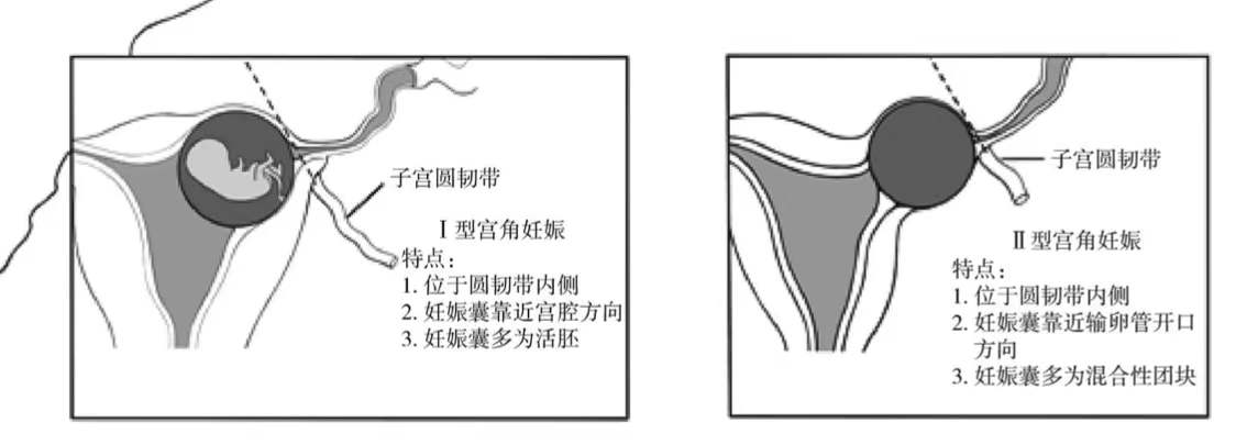 孕囊偏左侧宫角示意图图片