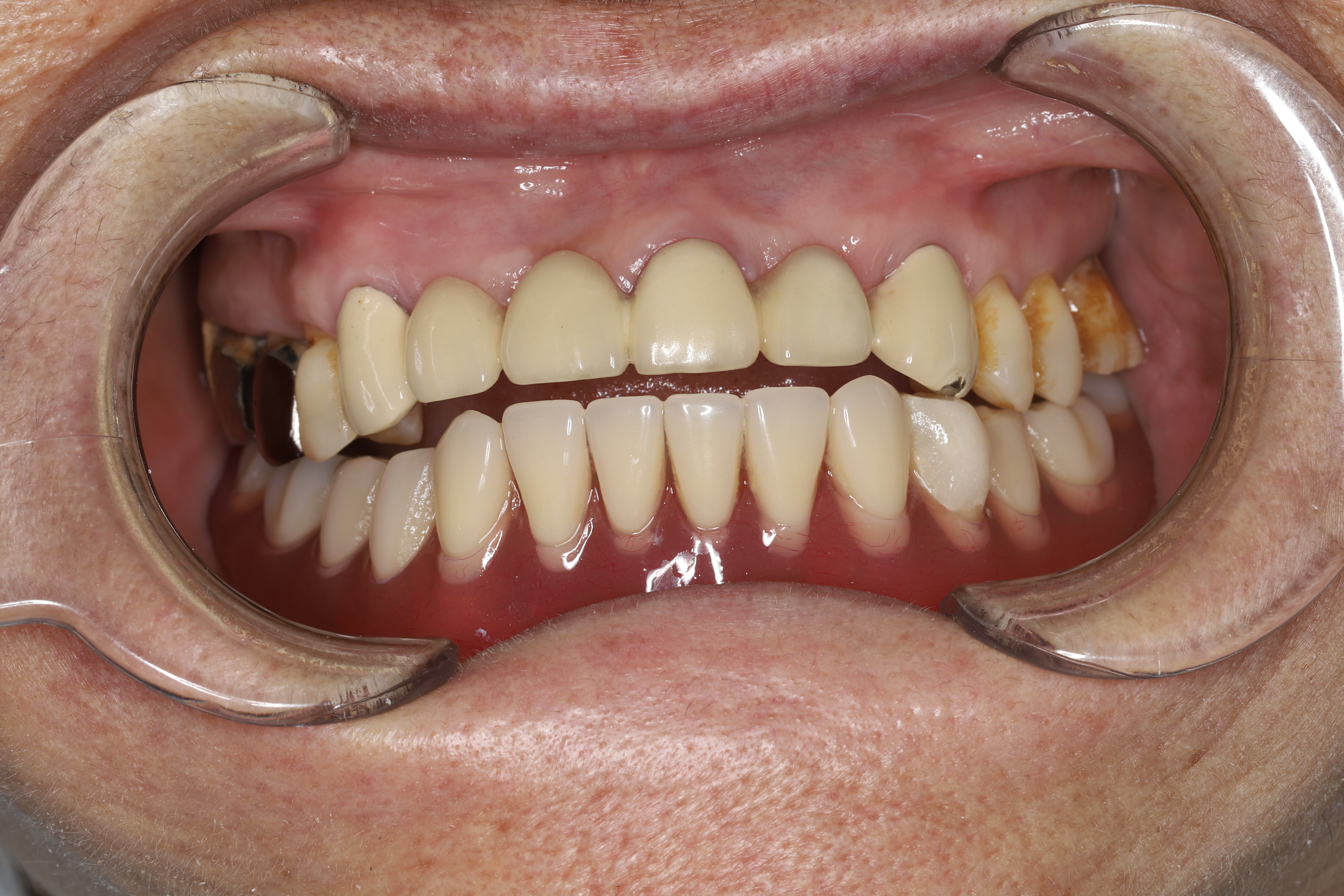 无牙颌或远端游离缺失的微创修复 - 好大夫在线