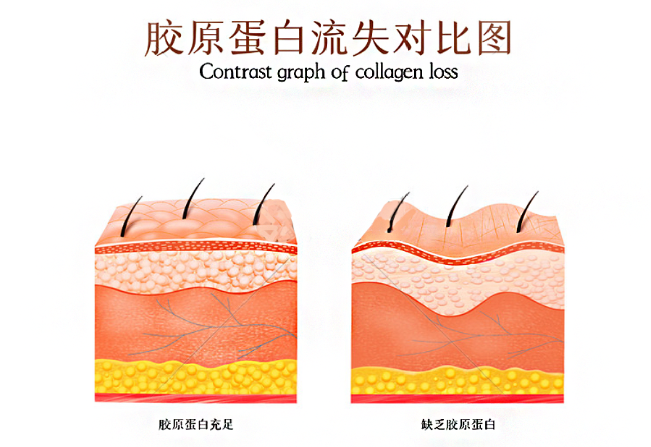 面部胶原蛋白流失.png