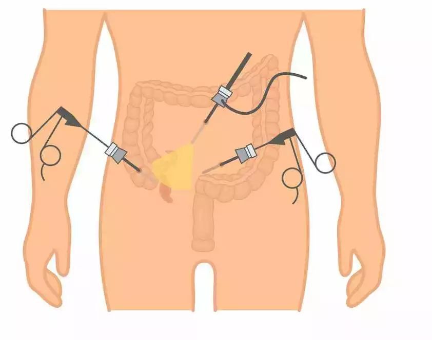 腹腔镜阑尾炎三个孔图片