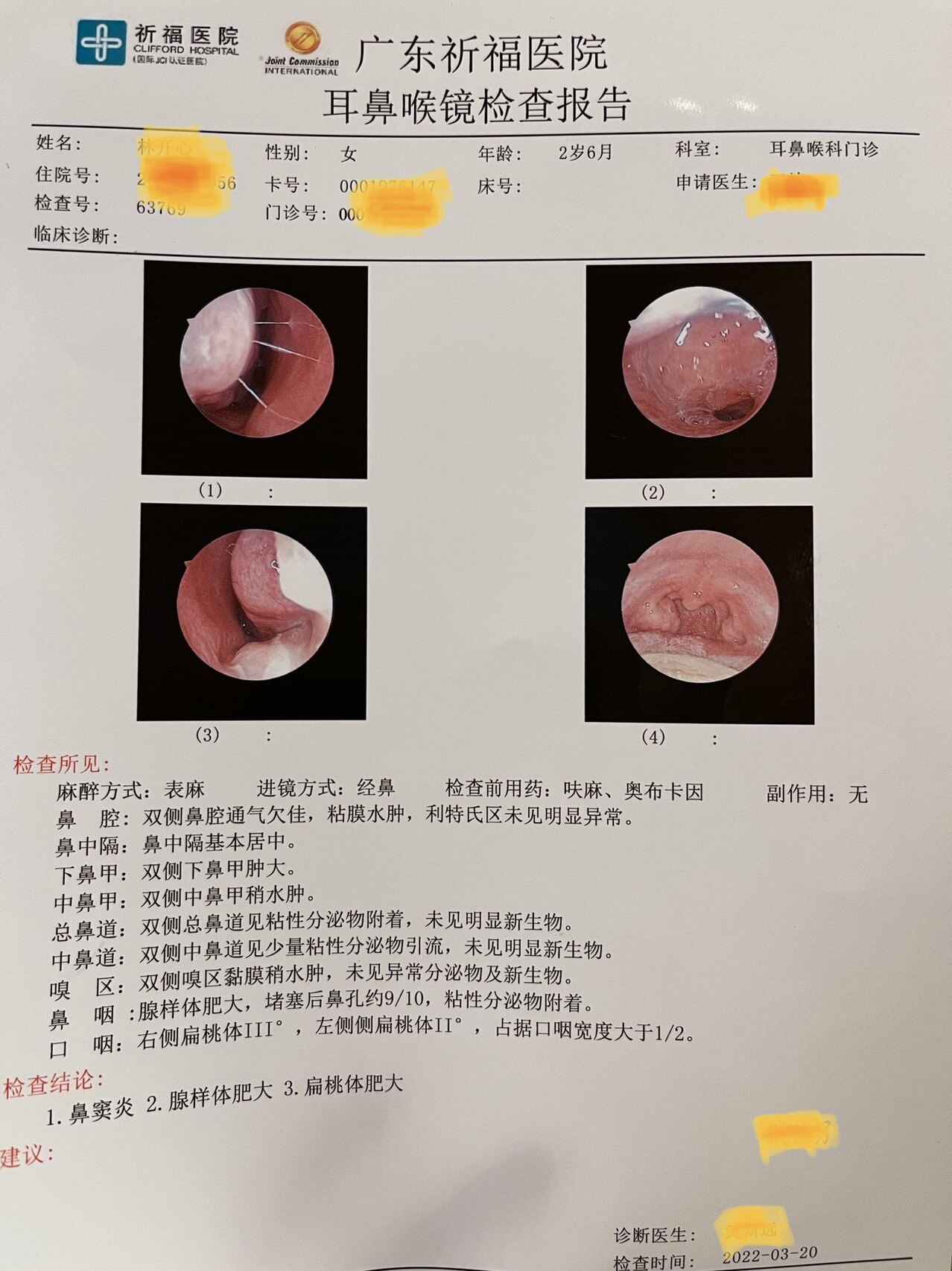 腺樣體肥大和扁桃體肥大會影響患兒的生長發育建議儘早手術治療早日撥