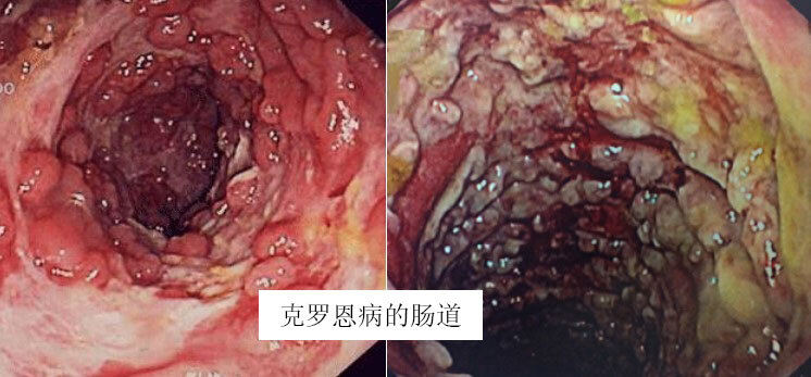 细菌性肠炎等病程:多为急性病程,2周多可痊愈症状:腹泻,呕吐,发热等