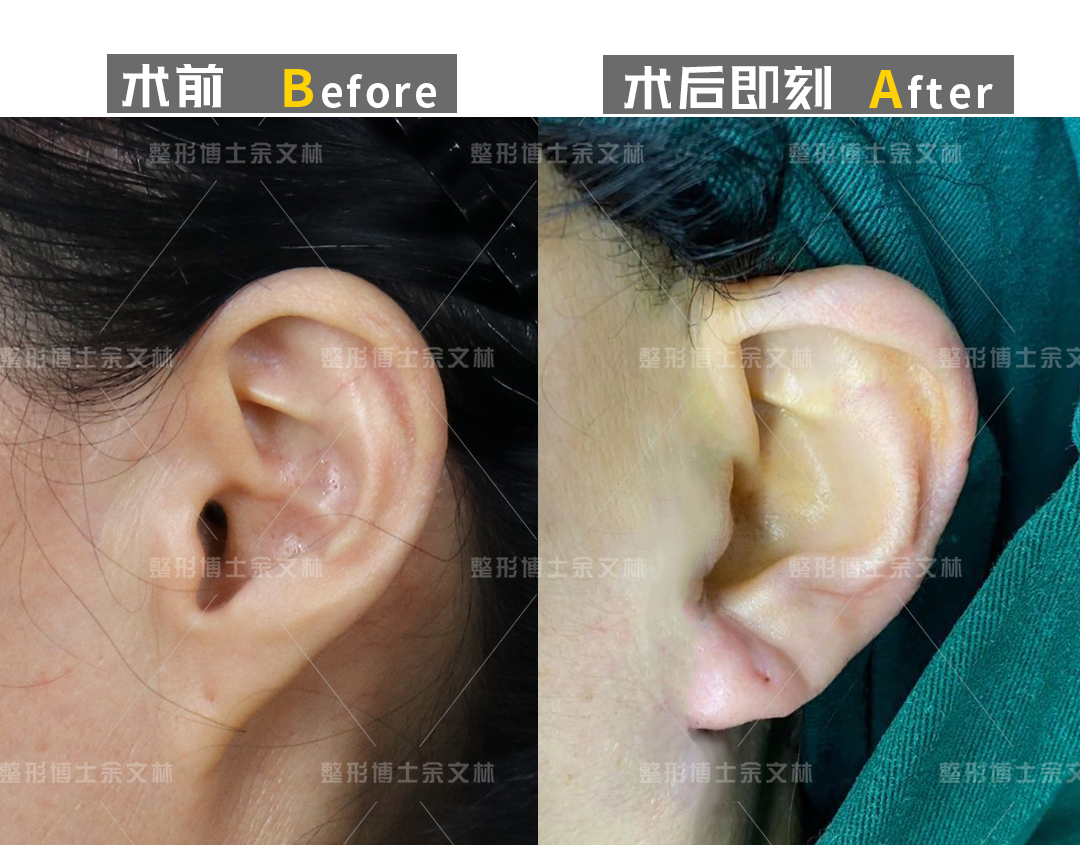 全耳再造术不可忽视的5大手术细节是什么呢 - 知乎