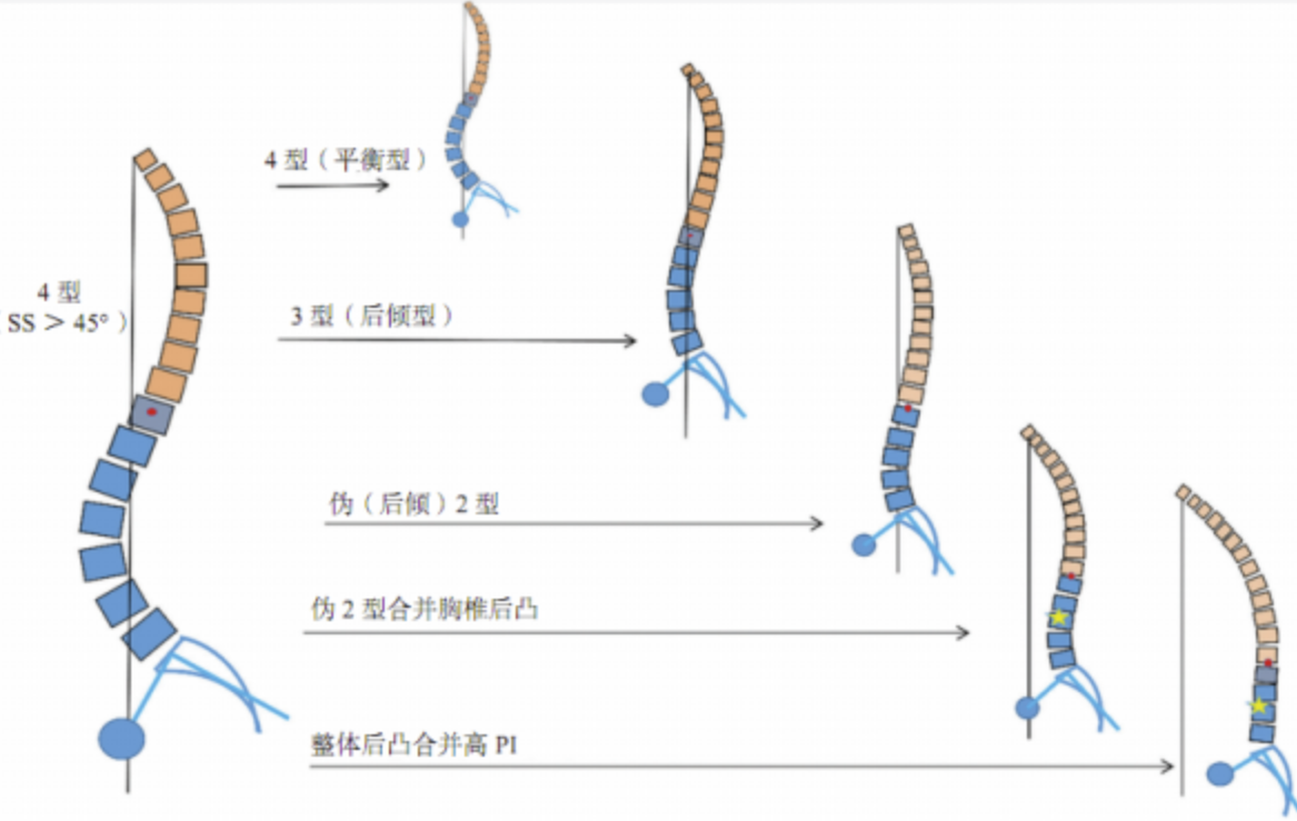 roussouly脊柱矢狀面理論一 - 好大夫在線