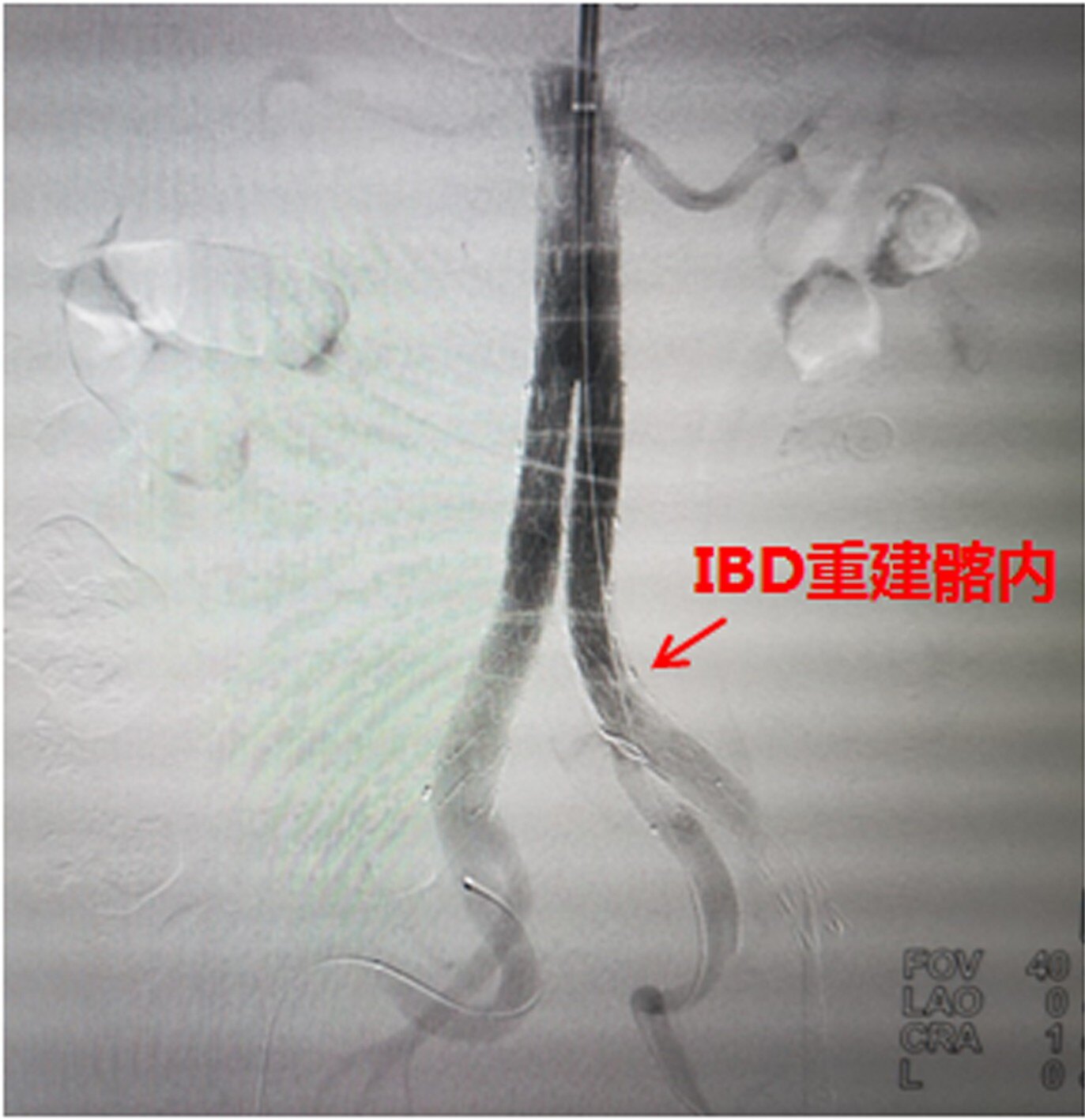 髂动脉分支装置(iliac branch device, ibd)是动脉瘤腔内治疗时重建髂