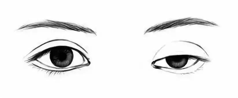 多种因素影响导致,如骨性结构眼眶发育异常,明显表现为高低眉,高低眼