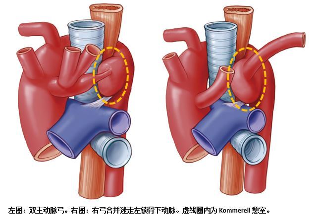 输尿管憩室图片