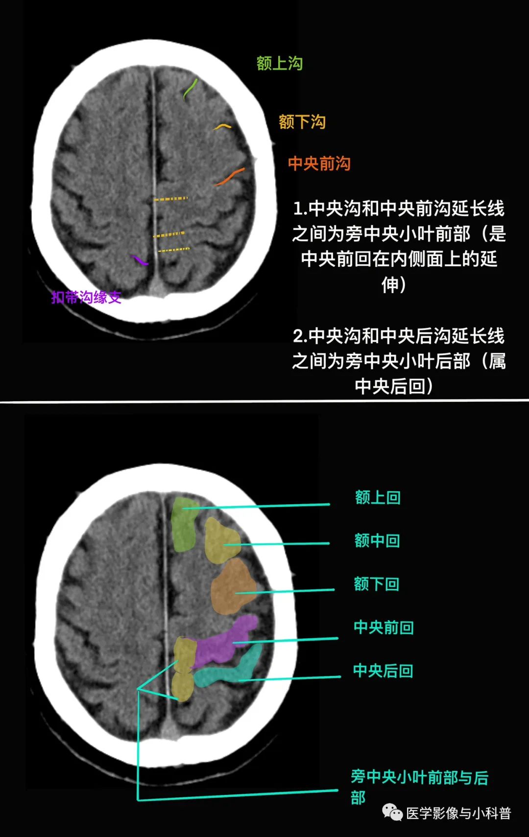 第一步:先找中央沟,中央沟前为额叶,后为顶叶