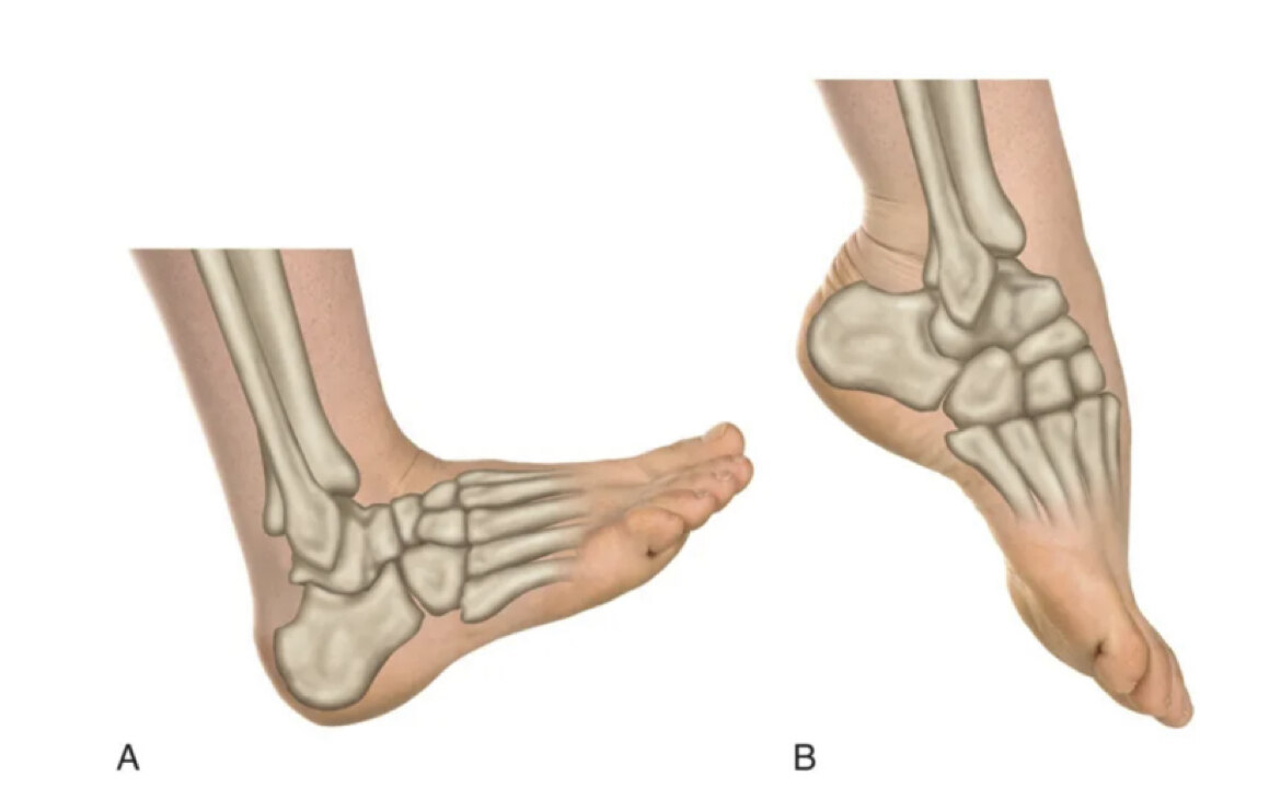 时,宽大的距骨前部进入关节窝内,卡扣锁定,关节稳定;但在跖屈(图b,绷