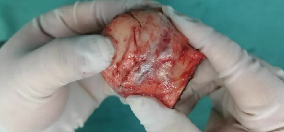 刚塌陷的股骨头肉眼所见_股骨头坏死_股骨头坏死介绍 - 好大夫在线