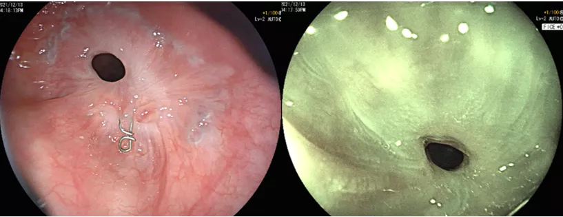 胃镜检查的时候,发现老汉食管手术的吻合口已经狭窄的非常严重,只剩下