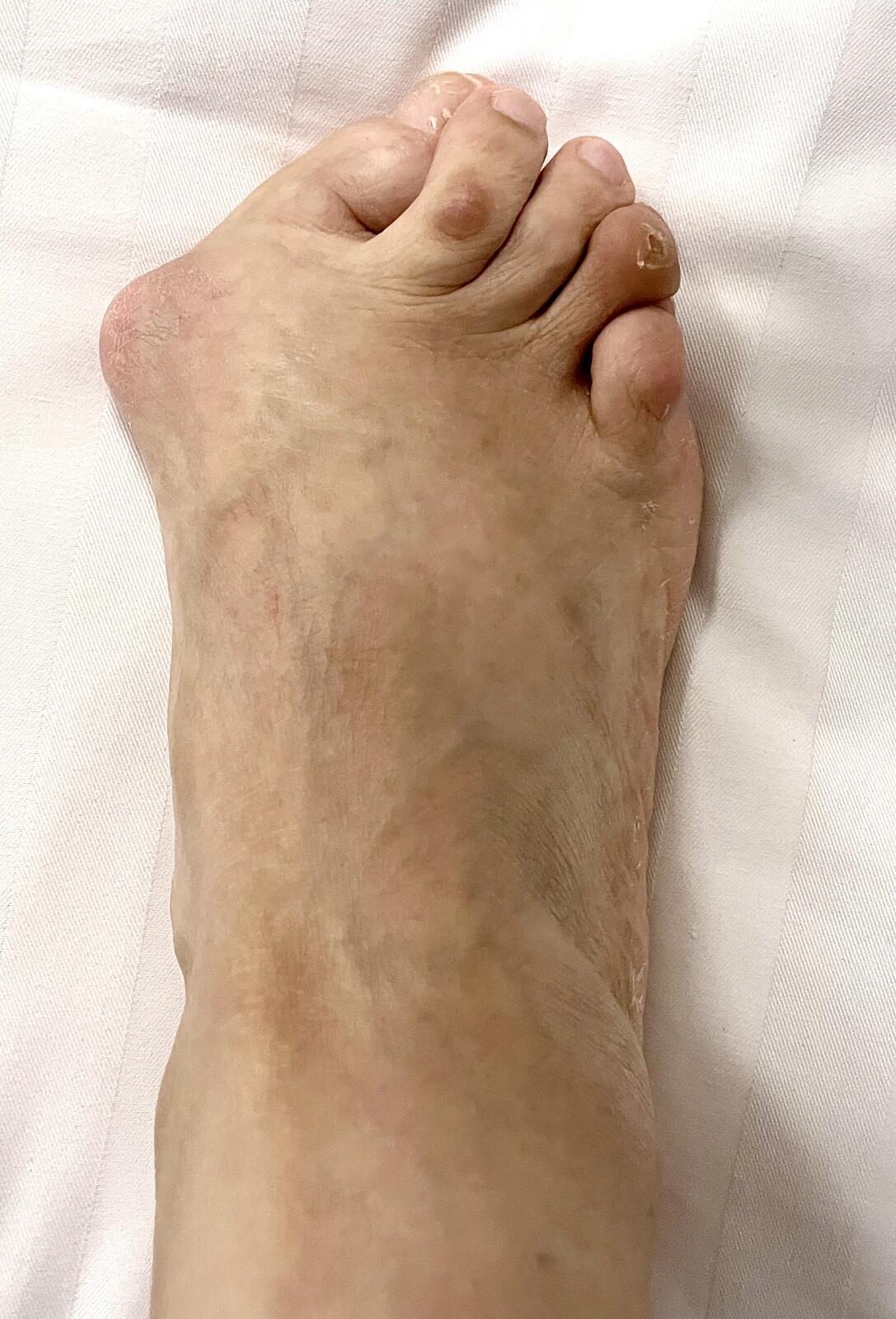 类风湿足—踇外翻爪形趾与跖痛症疑难病例报告之二