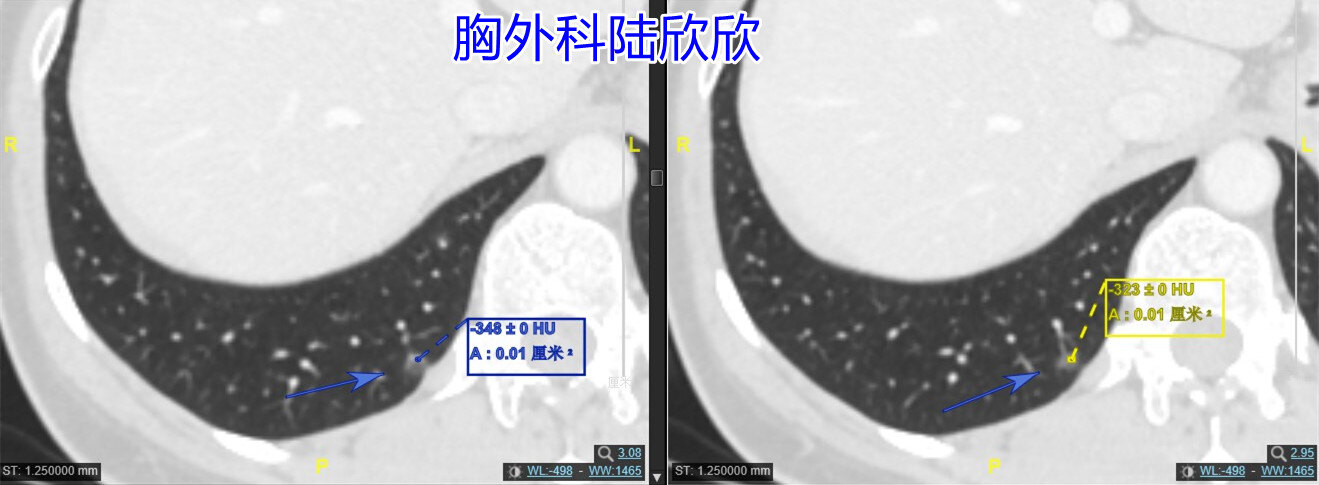 右下1薄层两张图CT值副本.jpg