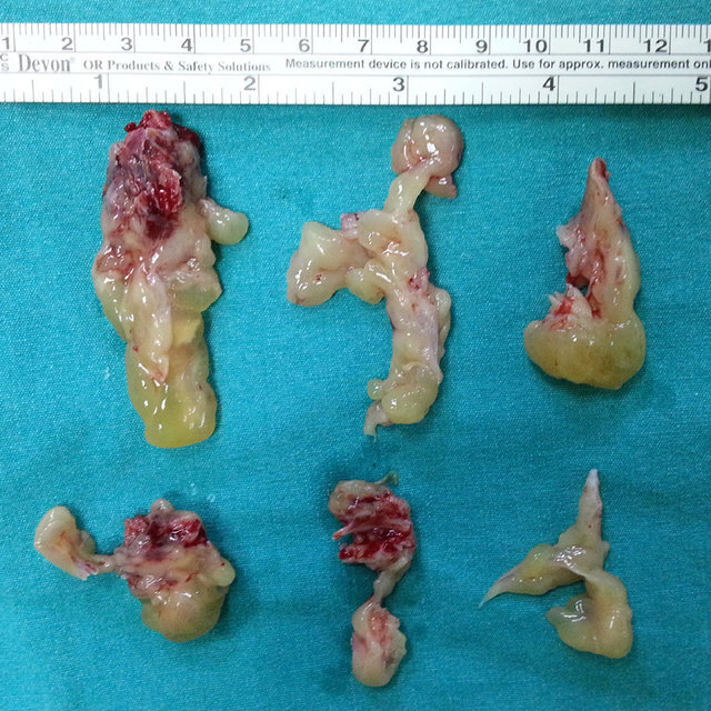 Removed-pathological-tissues-at-the-operation-They-include-separate-osseous-mass_Q640.jpg