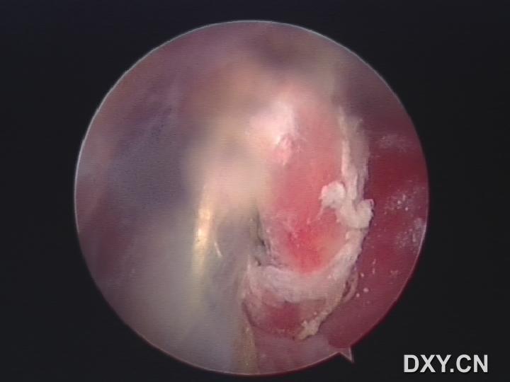 岡上肌鈣化性肌腱炎