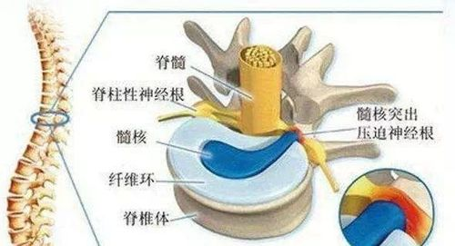 吃什么药能缓解腰椎间盘压迫神经 2YYBAGIu9luAVngPAALxWnzj-1U110.png?_ms_=2bd8