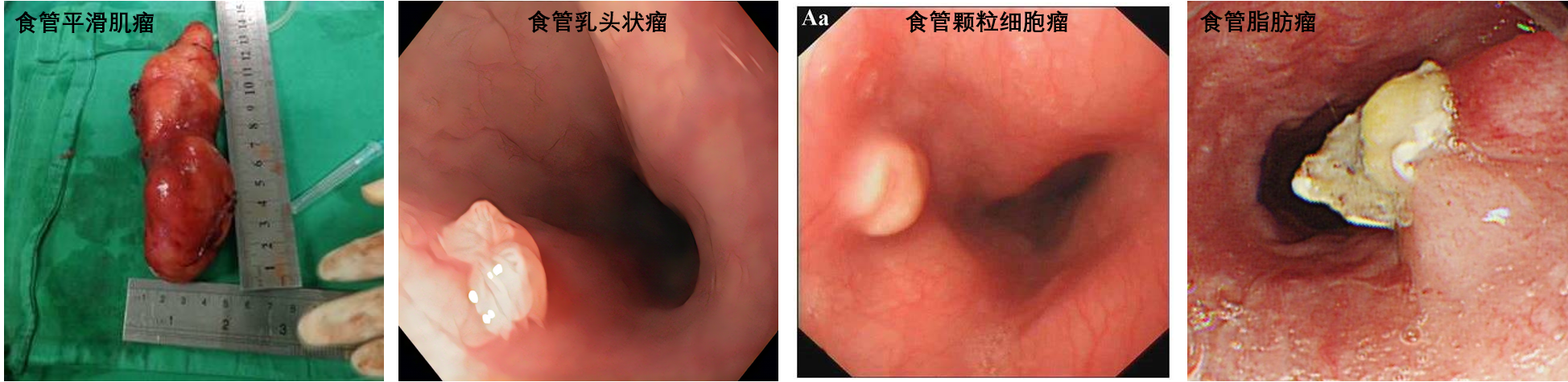 食管乳头状瘤样增生图片