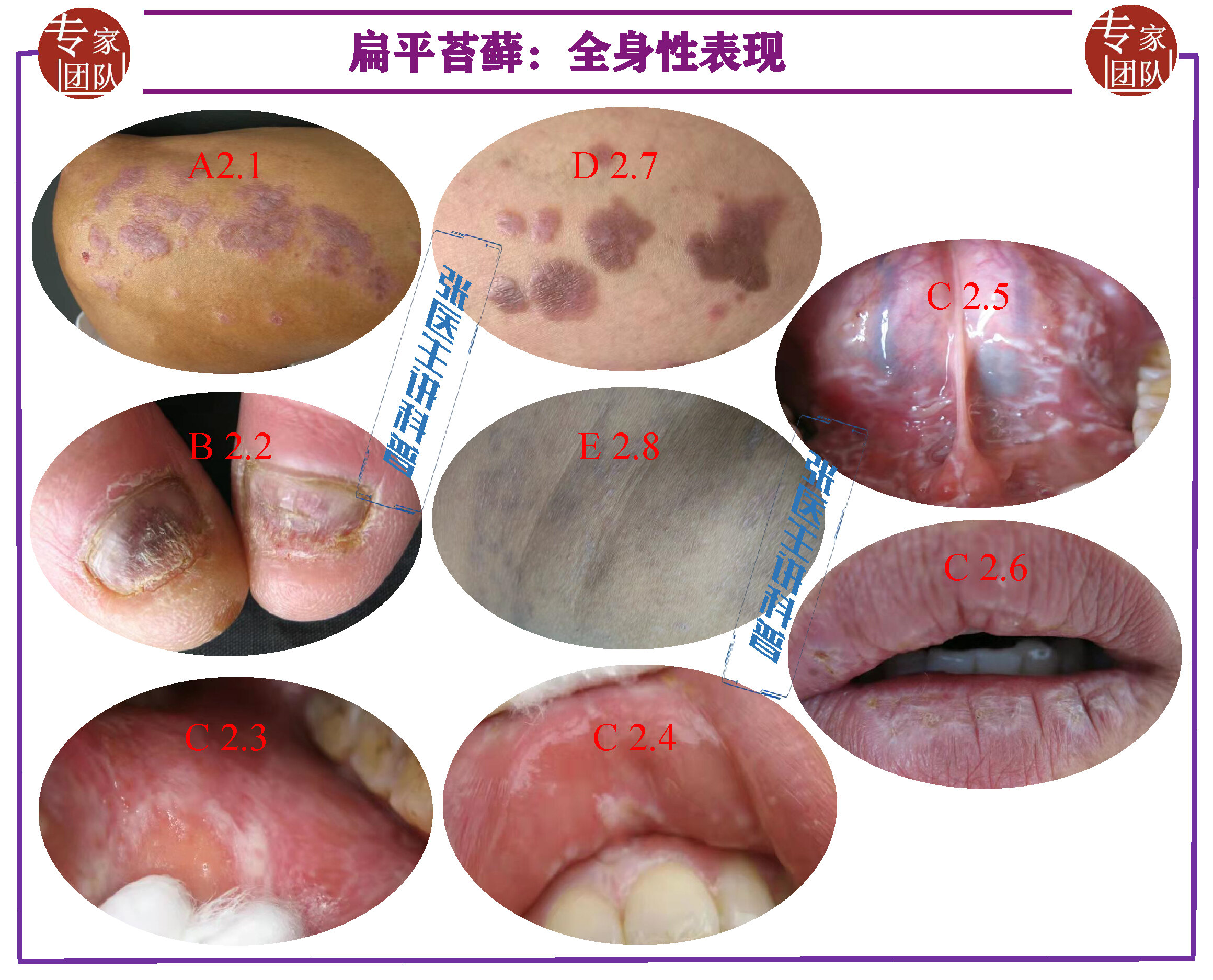 扁平苔藓:全身性表现.jpg