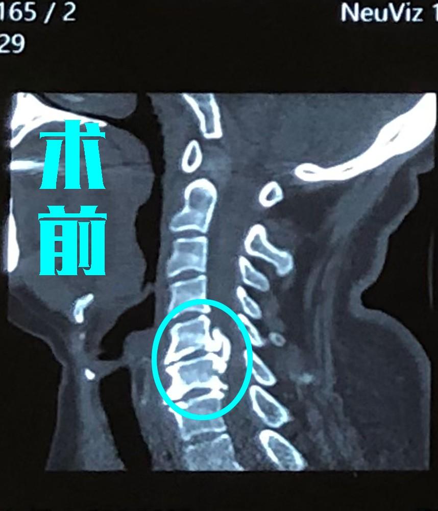 颈椎棘突图片图片