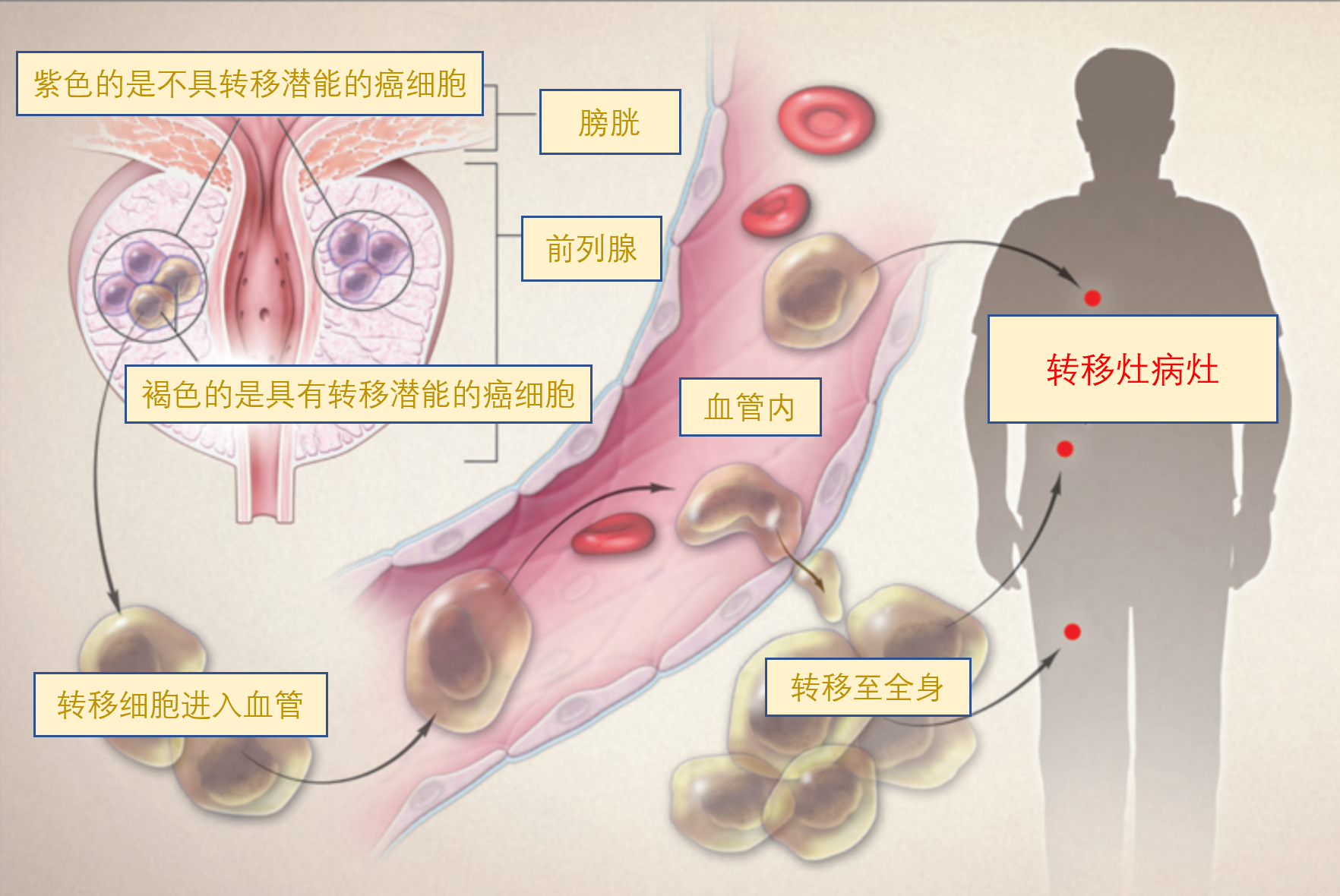 为什么hifu刀可以进行前列腺癌局部治疗,并保留前列腺?