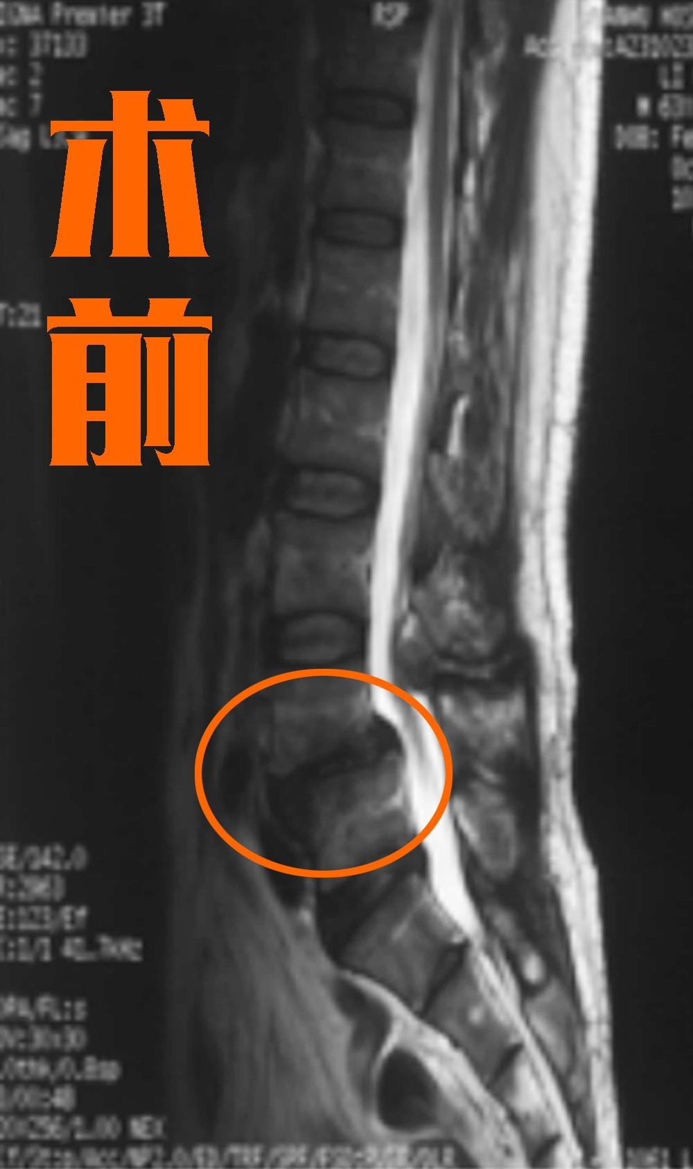 腰椎滑脱一定要手术吗能按摩手法按回去吗