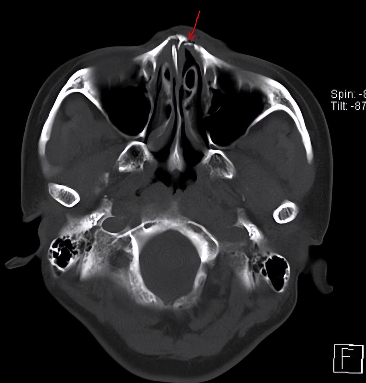 入院后有做了ct检查发现鼻中隔也是骨折偏曲了,这次安排了全麻鼻内镜