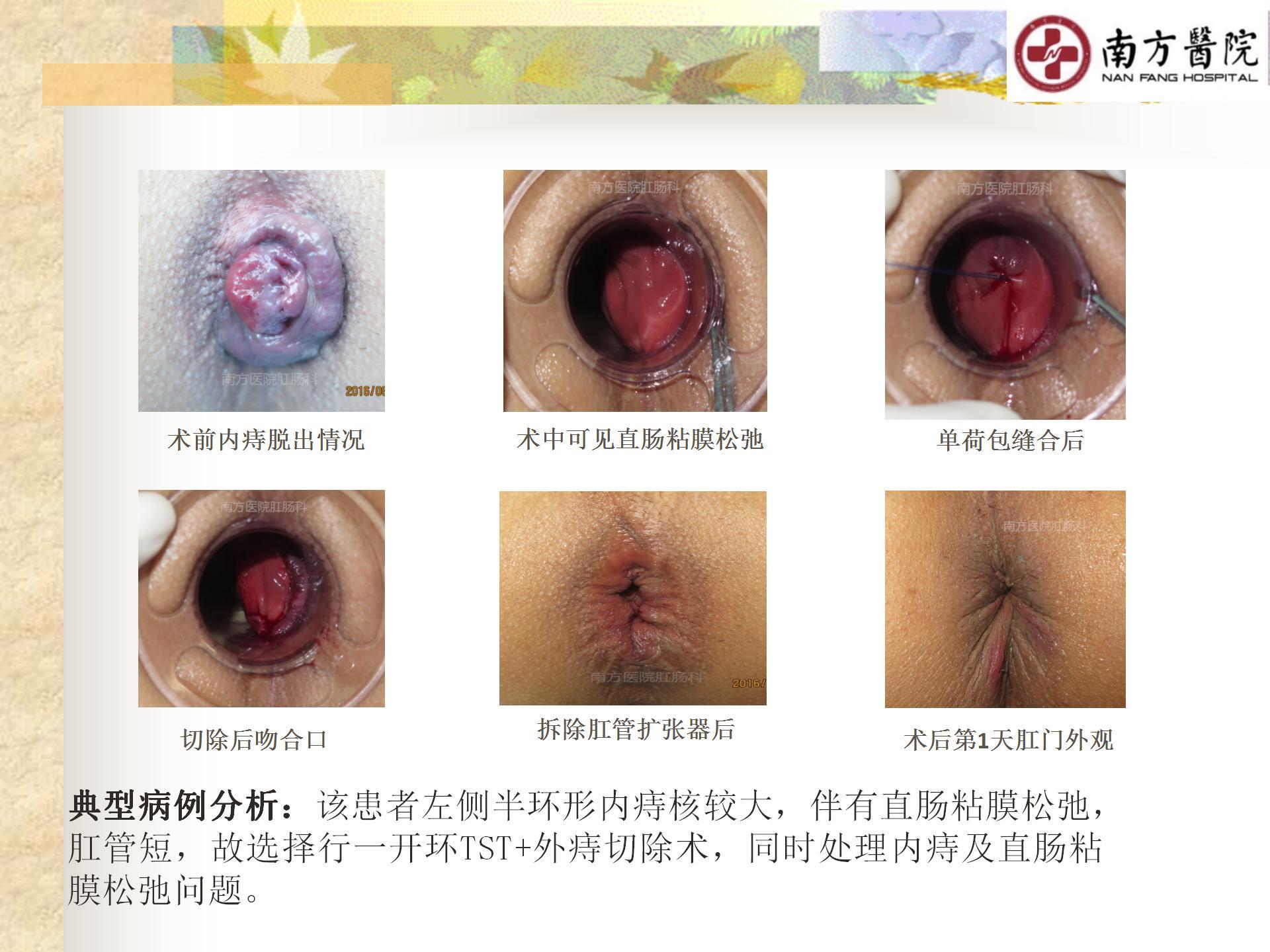 痔的精准化规范化微创化治疗之痔脱出1_18.jpg