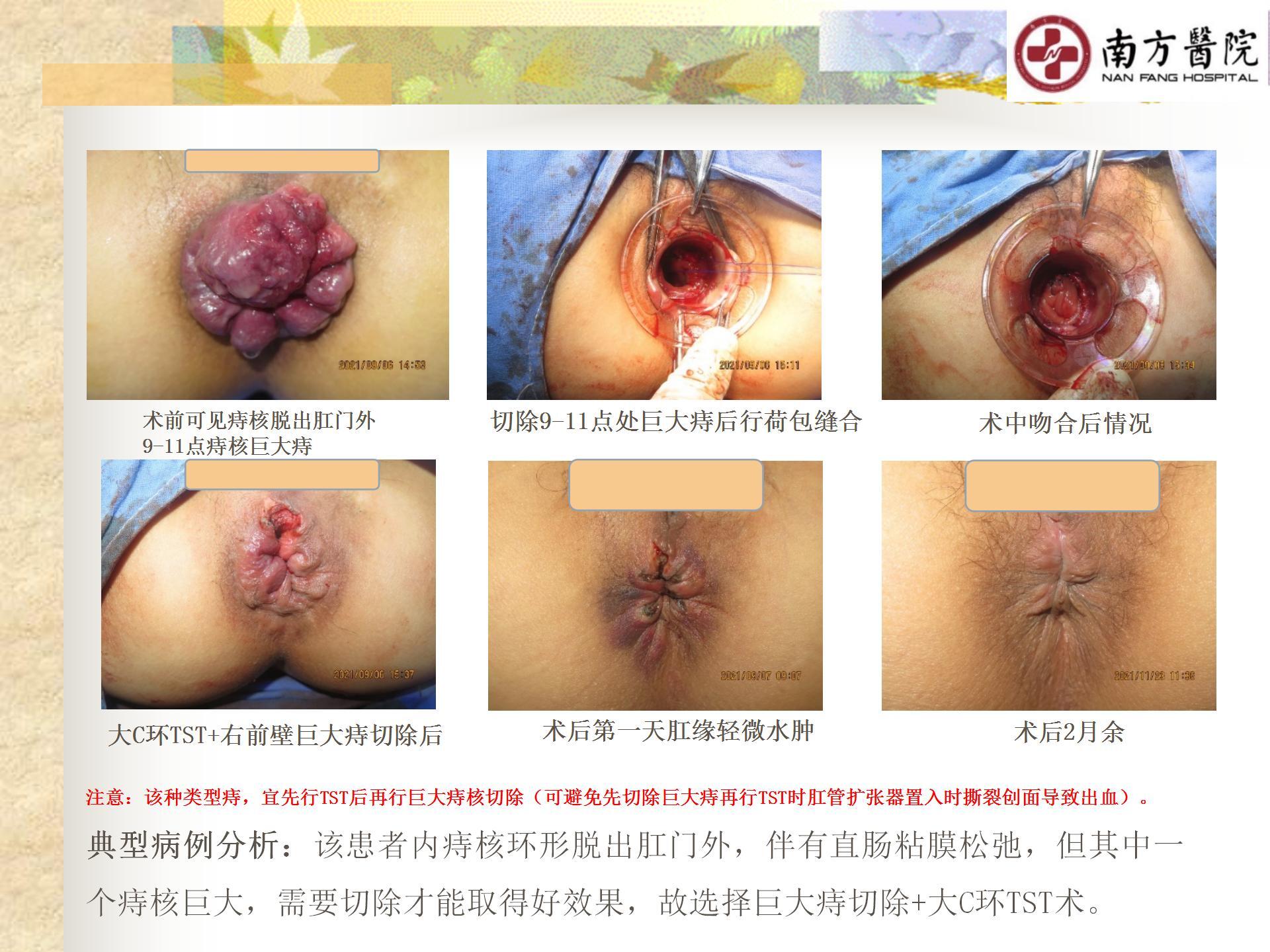 痔的精准化规范化微创化治疗之痔脱出1_28.jpg