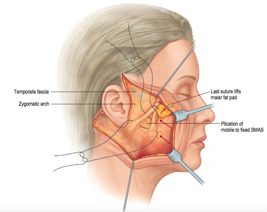 SMAS plication 1.jpg