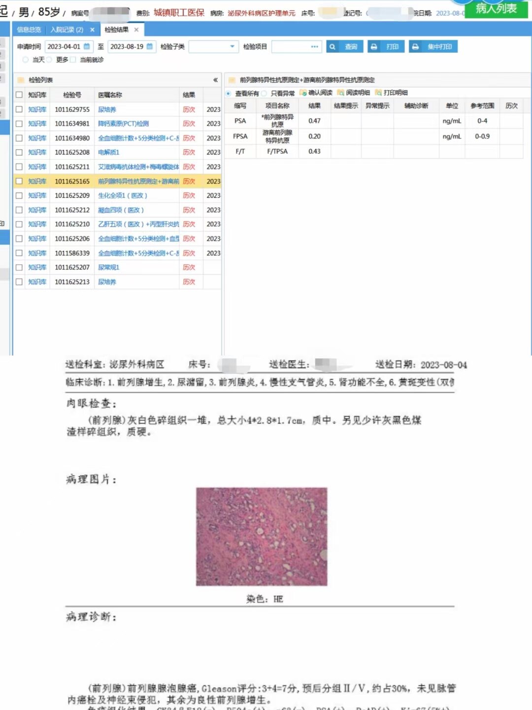 psa升高怎么办？