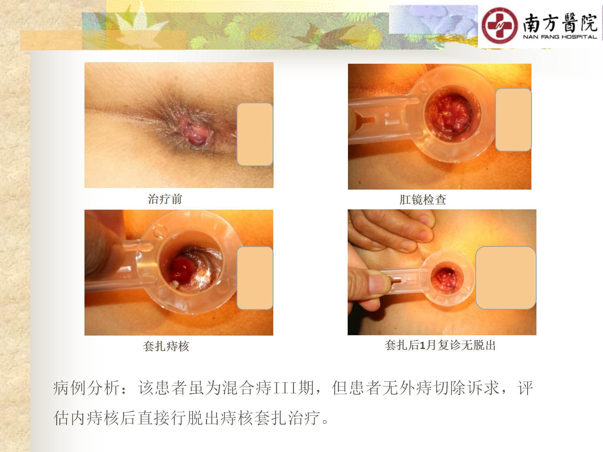 痔的精准化规范化微创化治疗之痔脱出2_08.jpg