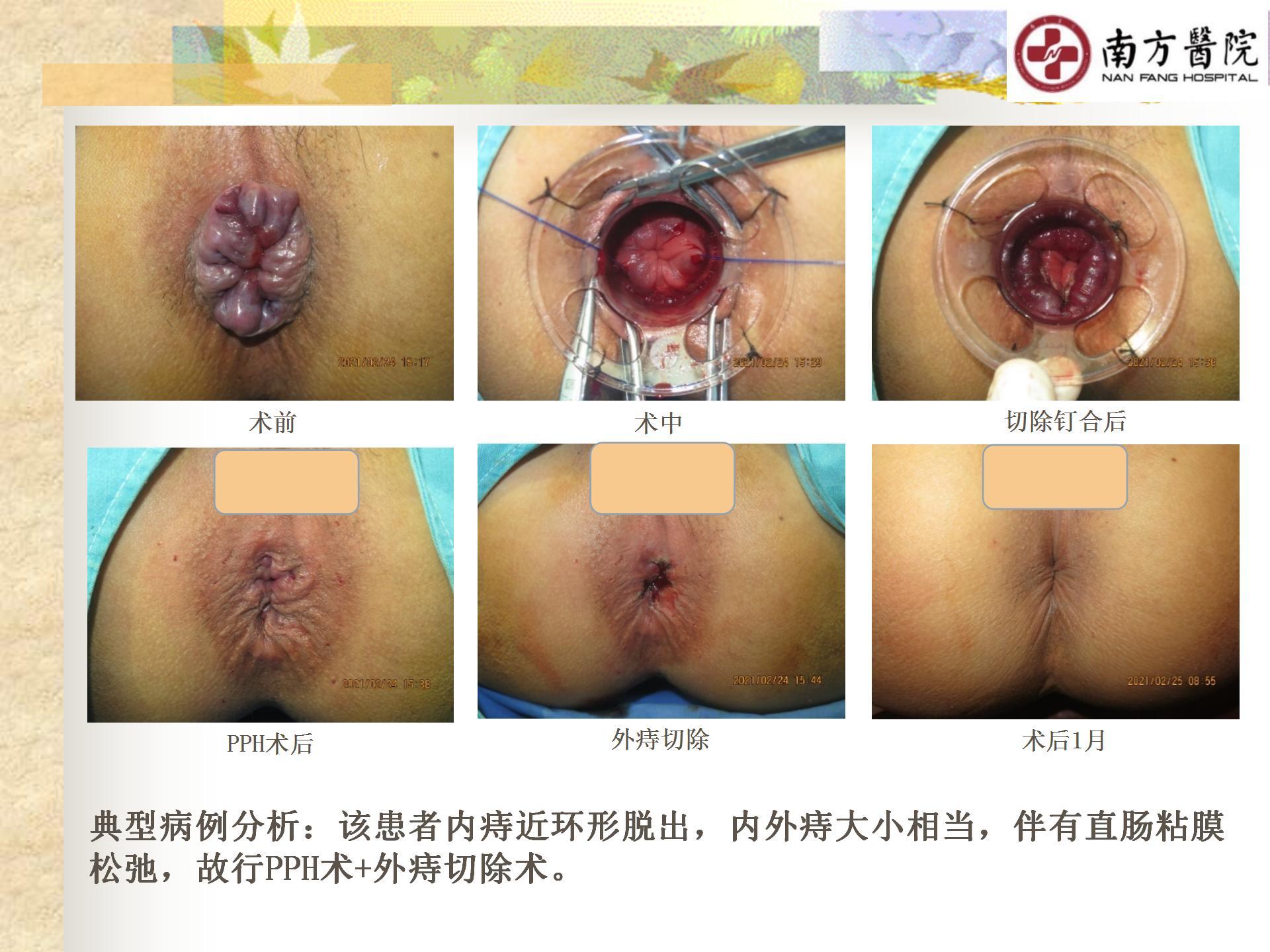 痔的精准化规范化微创化治疗之痔脱出2_19.jpg
