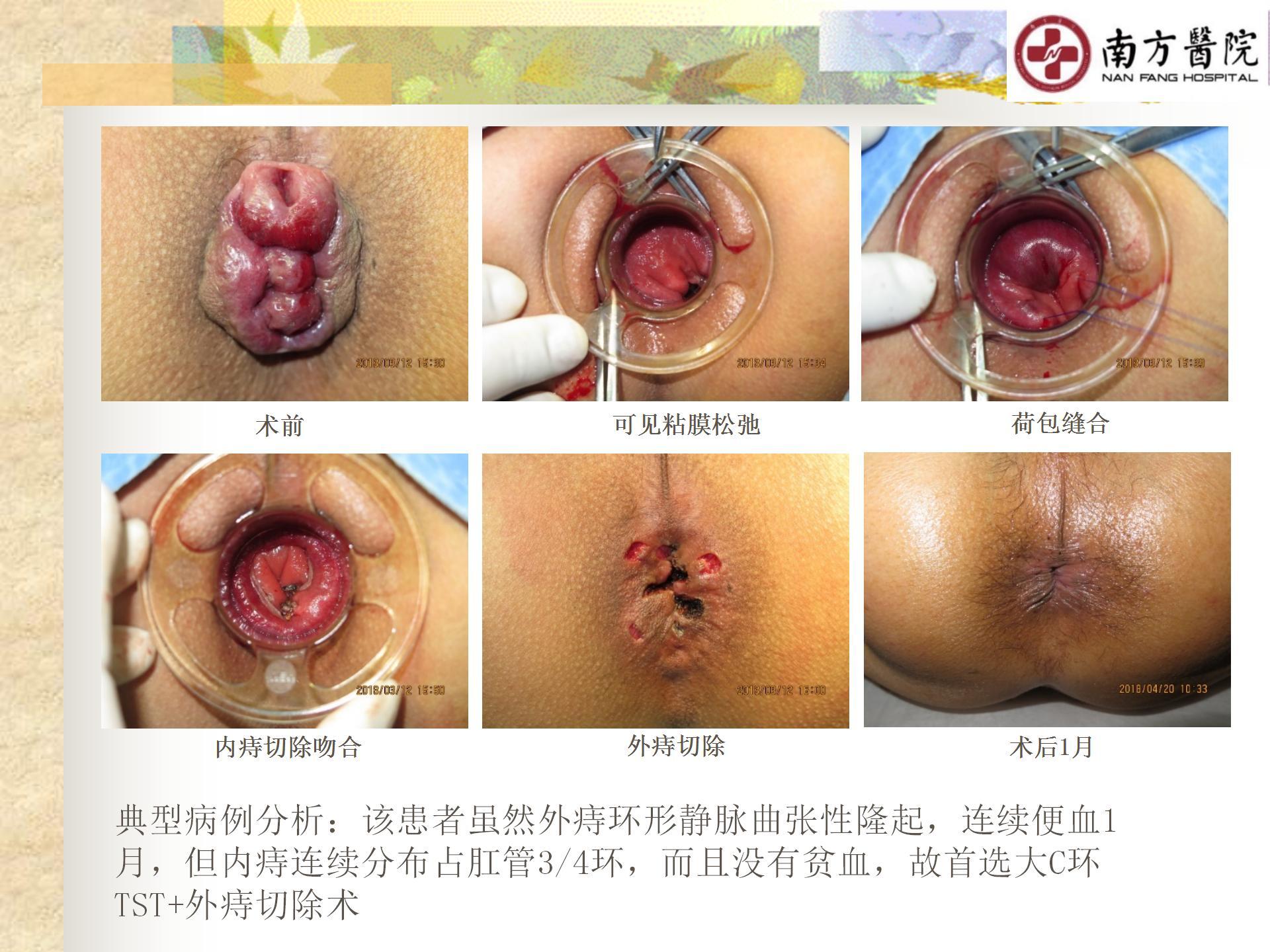 痔的精准化规范化微创化治疗之痔脱出2_15.jpg