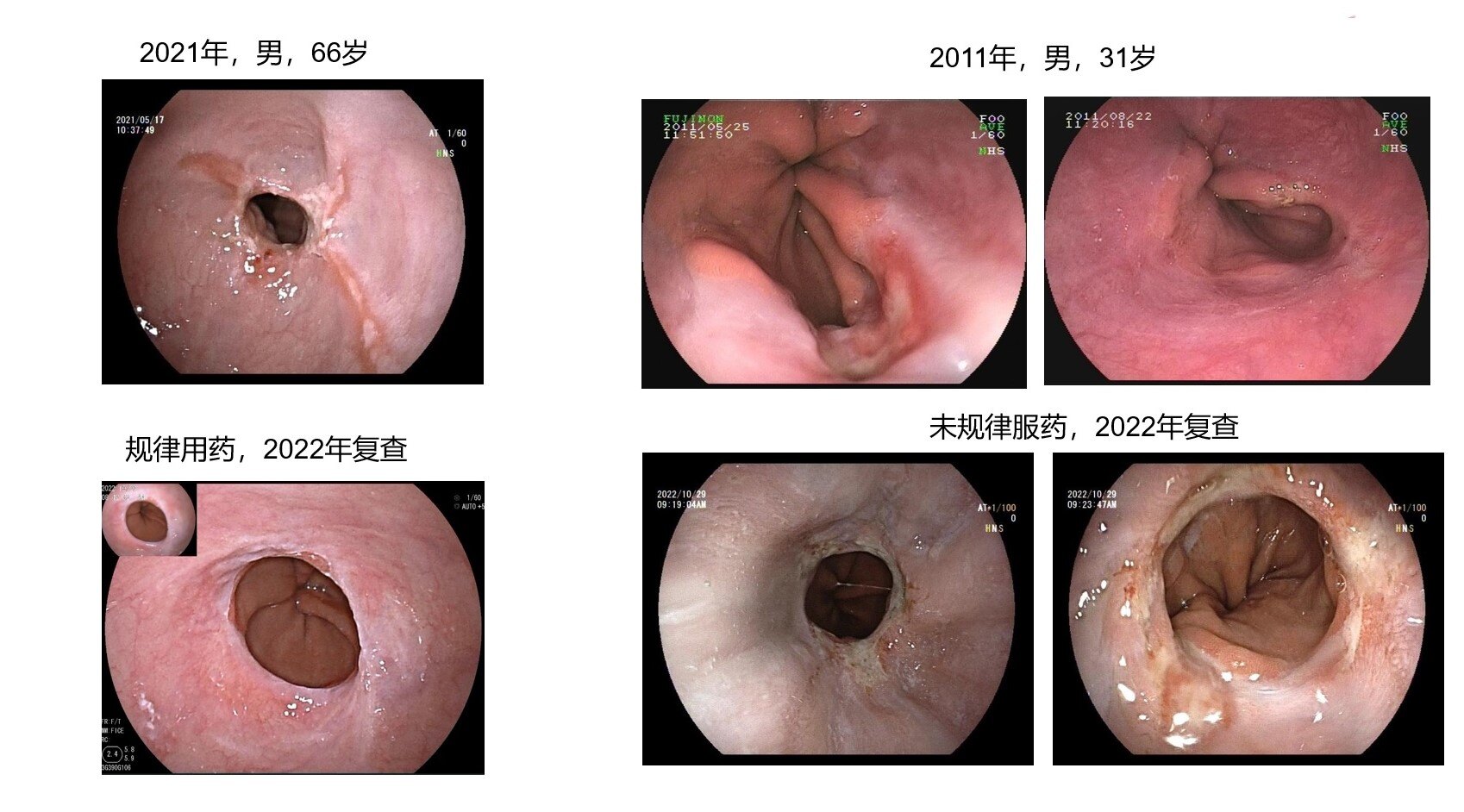 RE病例1-4.jpg