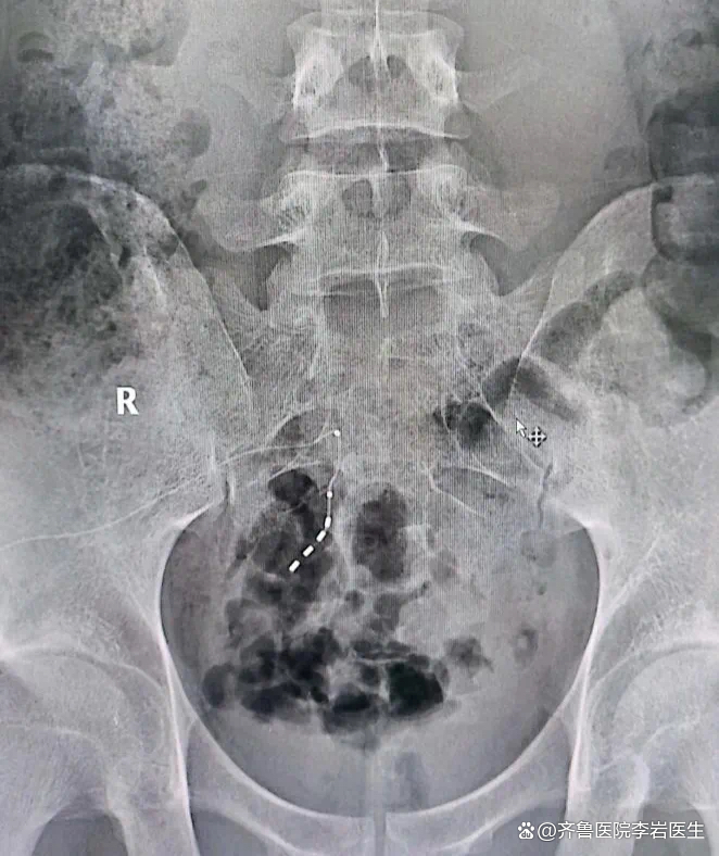 怎样快速解决排尿困难 24YBAGYIrxqARtkrAAWN0JQ1hvs016.png?_ms_=12f5